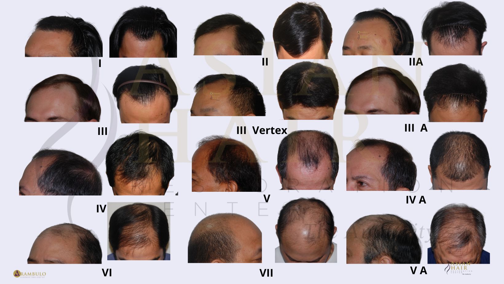 Androgenic Alopecia Best Treatment Options Dr Julieta Arambulo